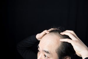抜け毛対策はまず原因の把握から！最新の研究からわかる抜け毛のタイプ
