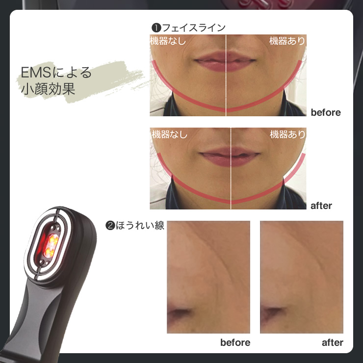 EMSによる小顔効果