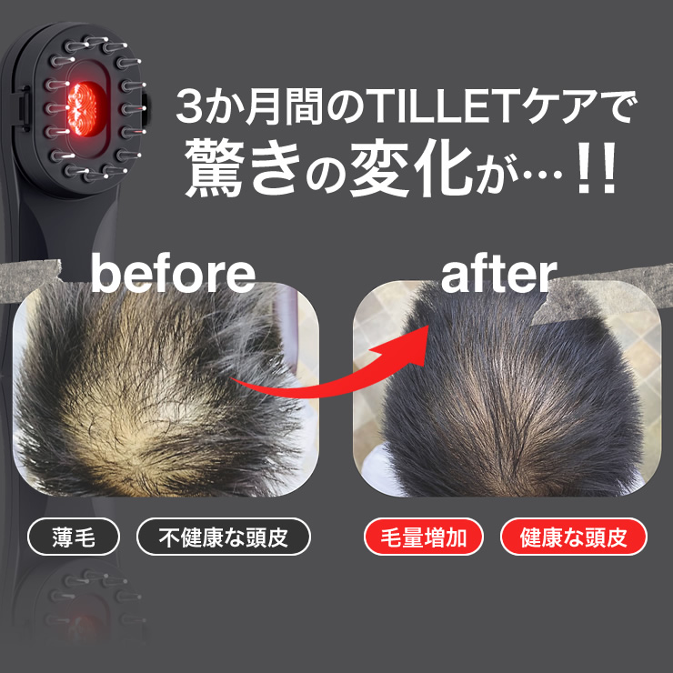 3ヶ月のTILLETケアで驚きの変化が